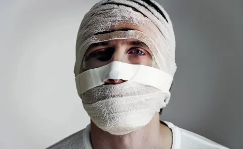 Degloved face injury showing exposed facial tissue